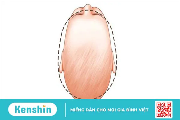 9 mẹo dân gian hỗ trợ chữa méo đầu ở trẻ sơ sinh hiệu quả