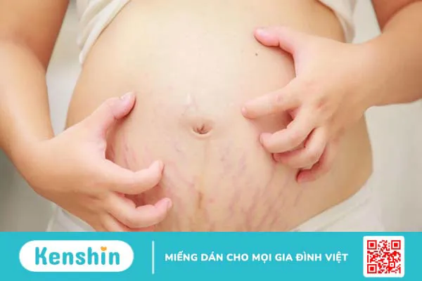 9 mẹo trị rạn da cho bà bầu an toàn tại nhà không thể bỏ qua!