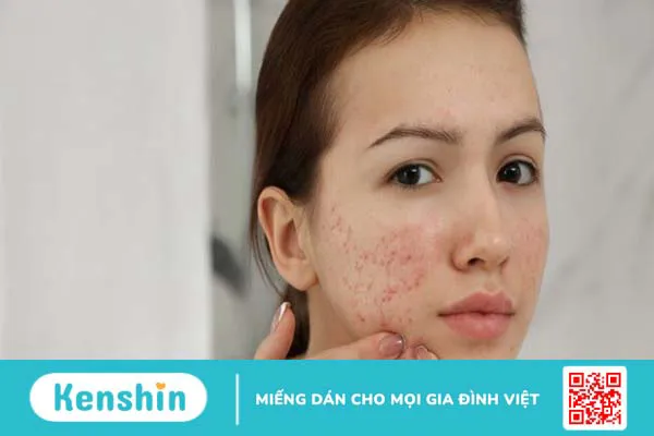 9 nguyên nhân dùng kem dưỡng ẩm bị nổi mụn và cách khắc phục hiệu quả