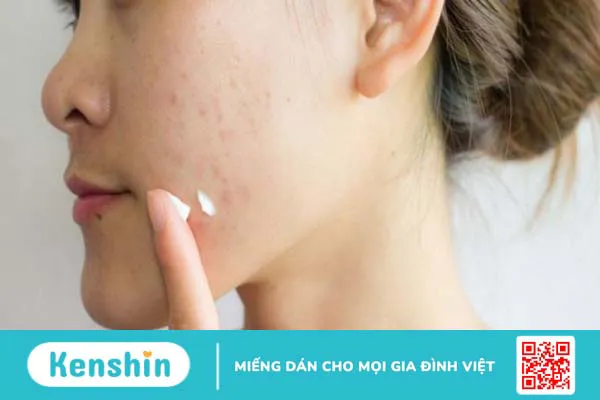 9 nguyên nhân dùng kem dưỡng ẩm bị nổi mụn và cách khắc phục hiệu quả