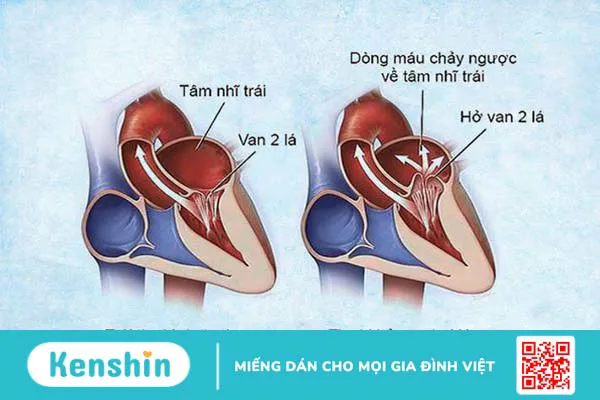 9 nguyên nhân suy tim thường gặp có thể bạn chưa biết