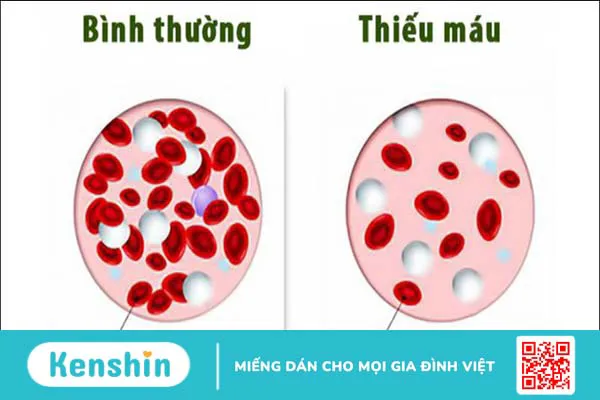 9 nguyên nhân thiếu máu phổ biến, dễ mắc phải bạn nên biết