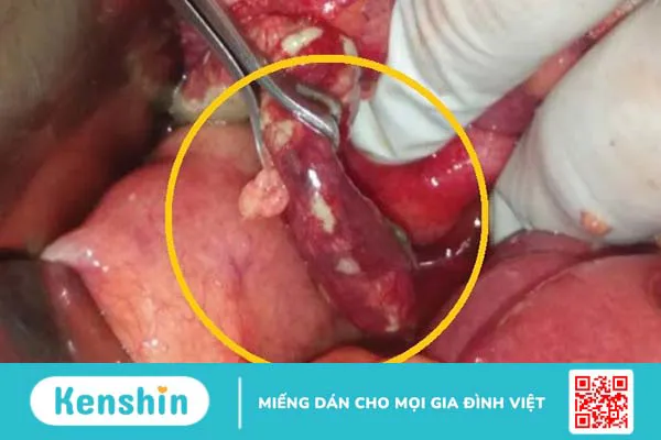 9 nguyên nhân viêm ruột thừa điển hình bạn cần phải lưu ý