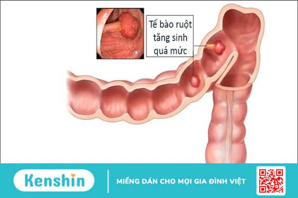 9 nguyên nhân viêm ruột thừa điển hình bạn cần phải lưu ý