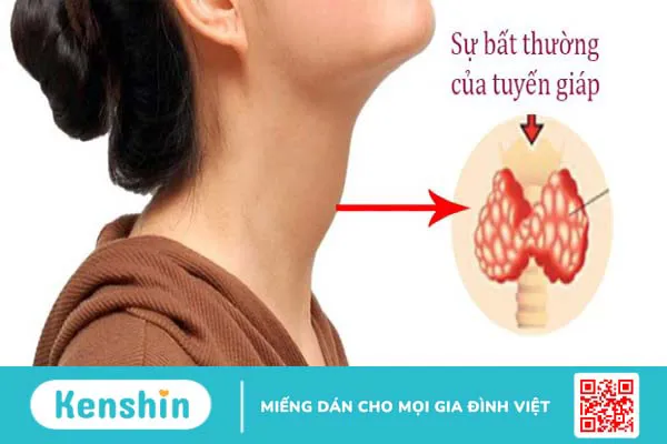 9 thực phẩm tốt dành cho người bệnh cường giáp