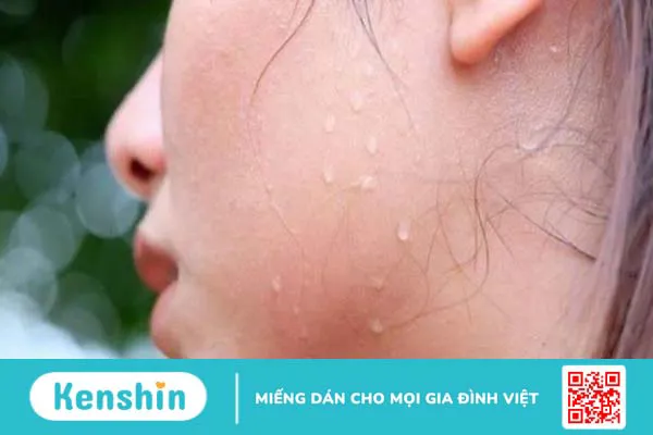 9 triệu chứng sốt siêu dễ nhận biết, cách điều trị và phòng ngừa