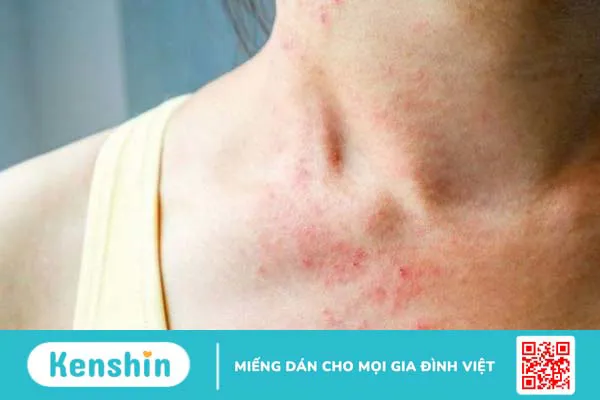 Acid alpha lipoic (ALA) là gì? Công dụng, cách dùng, tác dụng phụ, thực phẩm chứa ALA