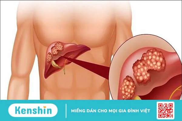 Ảnh hưởng trực tiếp của virus Covid-19 trên gan