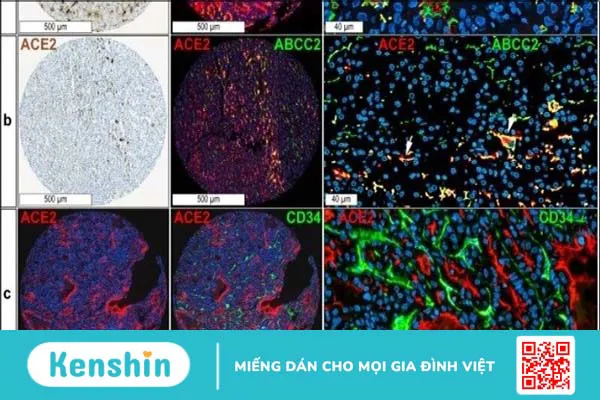 Ảnh hưởng trực tiếp của virus Covid-19 trên gan