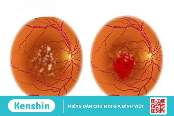 Ánh sáng xanh là gì? 9 tác hại của ánh sáng xanh với đôi mắt