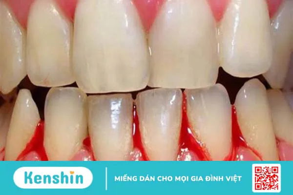 Bà bầu bị sốt xuất huyết khi mang thai có sao không? Lưu ý chăm sóc