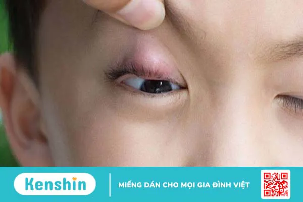 Bệnh chắp mắt ở trẻ em, nguyên nhân, triệu chứng và cách điều trị