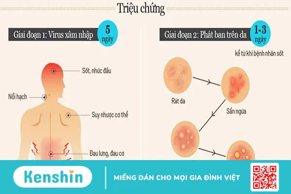 Bệnh đậu mùa khỉ và những điều nên biết