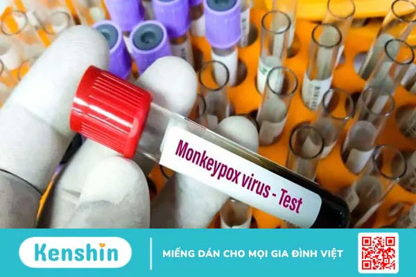 Bệnh đậu mùa khỉ và những điều nên biết