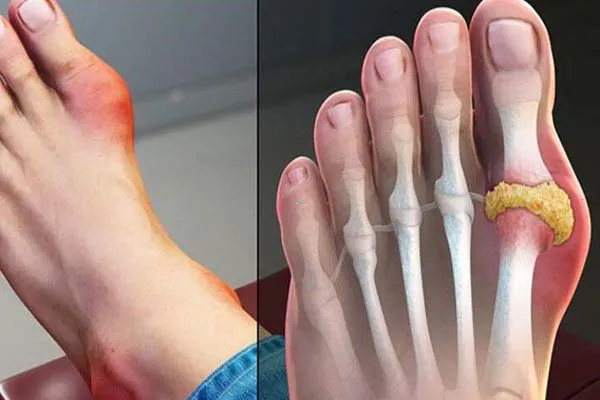 Bệnh gút (gout) kiêng ăn gì? 6 loại thức ăn bạn nên tránh