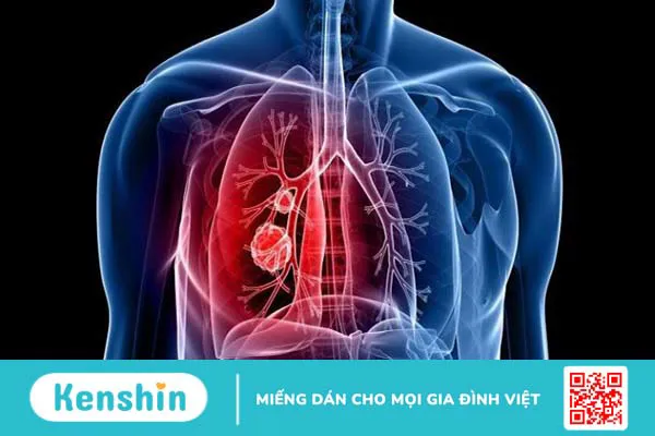 Bệnh hen suyễn có lây truyền không? Cách điều trị và phòng ngừa