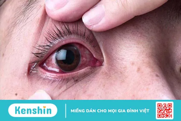 Bệnh khô mắt ở người già là gì? 9 cách phòng tránh khô mắt hiệu quả