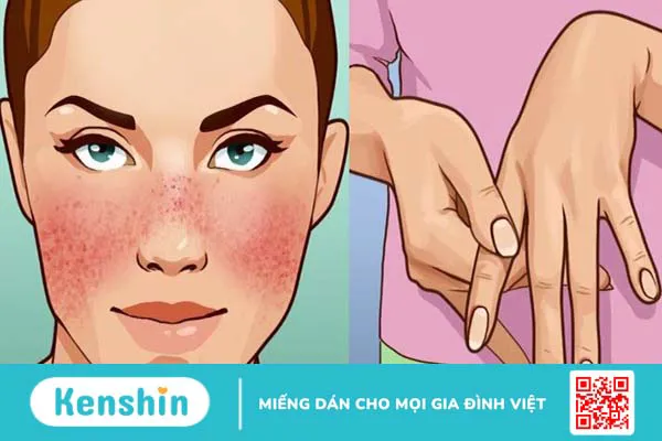 Bệnh lupus ban đỏ có lây không?