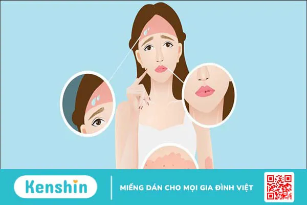 Bệnh lupus ban đỏ có lây không?