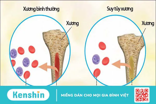 Bệnh lupus ban đỏ có lây không?