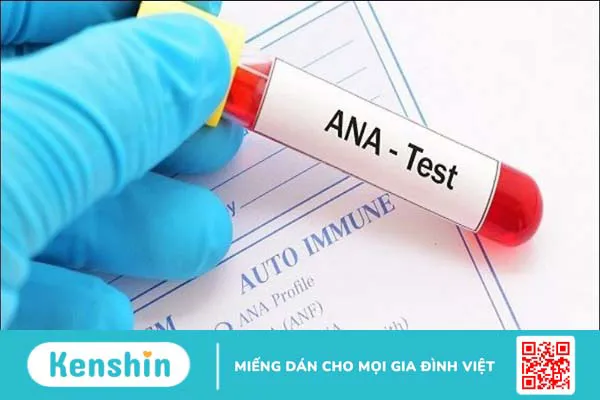 Bệnh lupus ban đỏ có lây không?