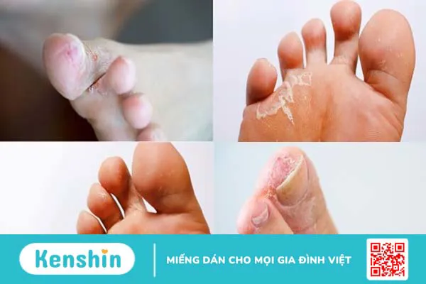 Bệnh nấm kẽ chân (nước ăn chân) – bệnh thường gặp mùa mưa bạn cần biết