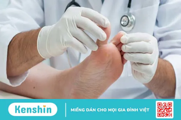 Bệnh nấm kẽ chân (nước ăn chân) – bệnh thường gặp mùa mưa bạn cần biết