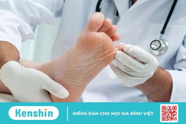 Bệnh nấm kẽ chân (nước ăn chân) – bệnh thường gặp mùa mưa bạn cần biết