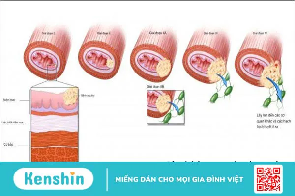 Bệnh nhân ung thư thực quản sống được bao lâu? Phương pháp điều trị