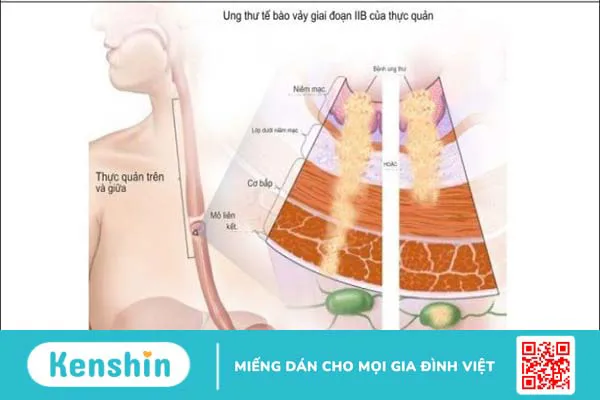 Bệnh nhân ung thư thực quản sống được bao lâu? Phương pháp điều trị