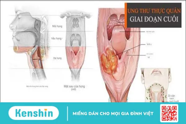 Bệnh nhân ung thư thực quản sống được bao lâu? Phương pháp điều trị