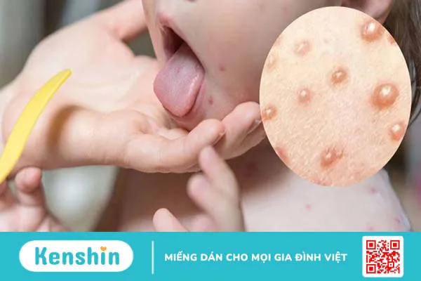 Bệnh thủy đậu bao lâu khỏi? Dấu hiệu nhận biết khỏi bệnh thủy đậu