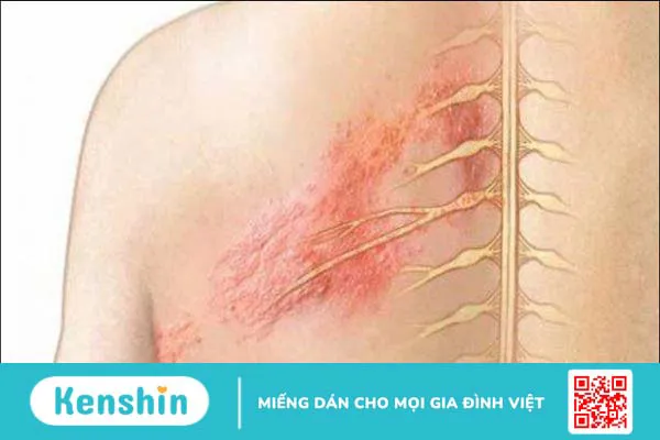 Bệnh thủy đậu bao lâu khỏi? Dấu hiệu nhận biết khỏi bệnh thủy đậu