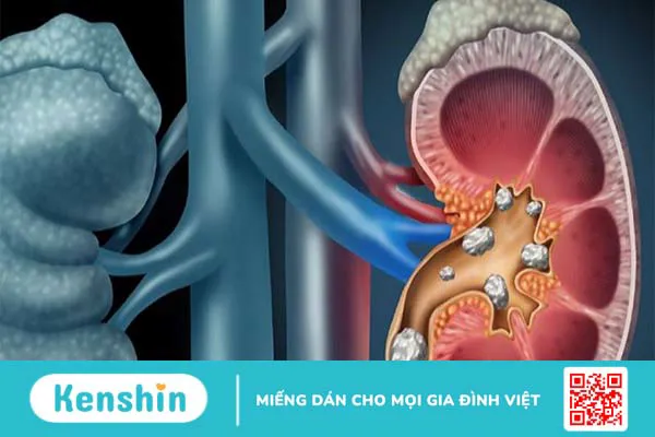 Bệnh tiểu đường có ăn được thịt gà không? 5 lợi ích và cách chế biến