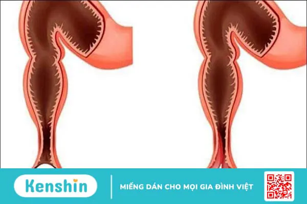 Bệnh tiêu hóa và 11 cách phòng chống bệnh đường ruột ngày nắng nóng