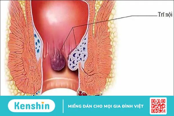 Bệnh trĩ nên ăn gì và kiêng ăn gì để giảm đau? Lưu ý trong chế độ ăn