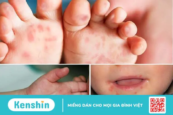 Bệnh truyền nhiễm là gì? Danh sách các bệnh truyền nhiễm thường gặp