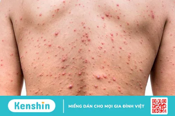 Bệnh truyền nhiễm là gì? Danh sách các bệnh truyền nhiễm thường gặp