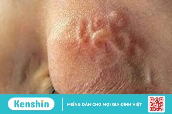 Bệnh truyền nhiễm là gì? Danh sách các bệnh truyền nhiễm thường gặp