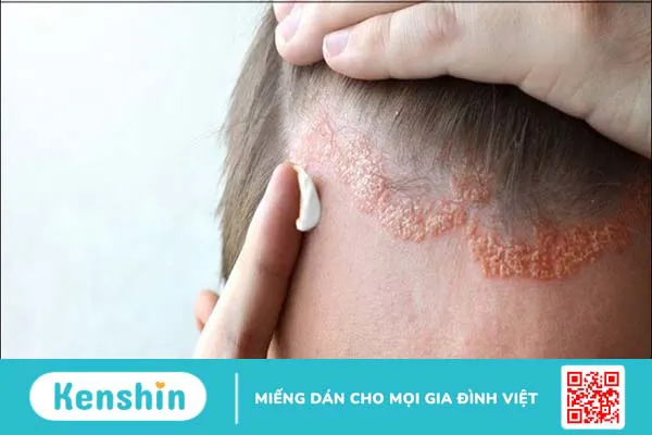 Bệnh vảy nến có lây không? Dấu hiệu và các đối tượng nguy cơ mắc