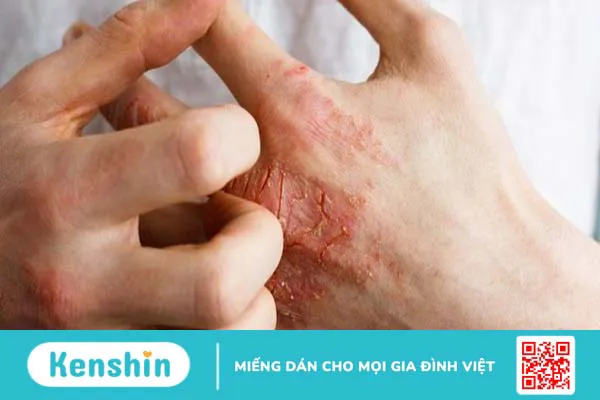 Bệnh vảy nến có lây không? Dấu hiệu và các đối tượng nguy cơ mắc