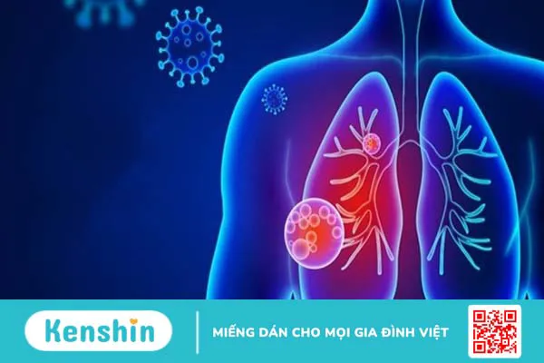 Bệnh viêm phổi cấp do nhiễm Virus corona