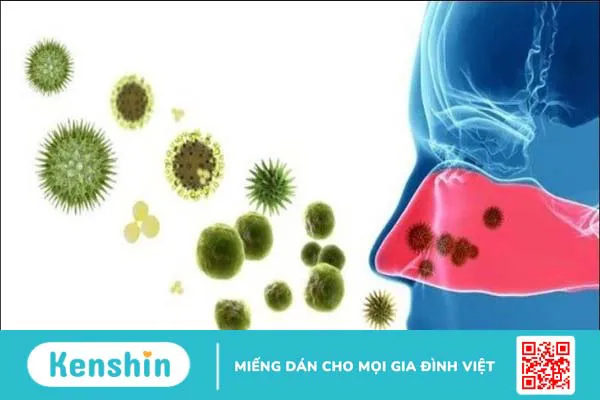 Bệnh viêm xoang có lây không? Cách phòng ngừa bệnh viêm xoang hiệu quả