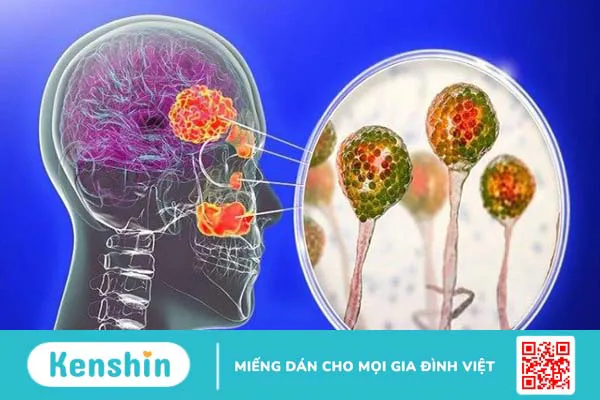 Bệnh viêm xoang có lây không? Cách phòng ngừa bệnh viêm xoang hiệu quả