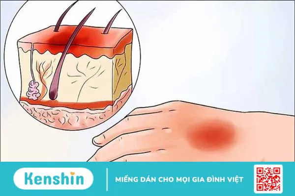 Bị bỏng kiêng ăn gì? 8 thực phẩm nên tránh để không bị sẹo, mau lành