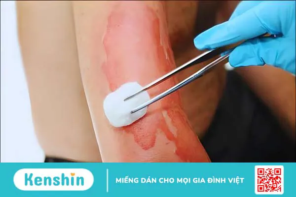 Bị bỏng kiêng ăn gì? 8 thực phẩm nên tránh để không bị sẹo, mau lành