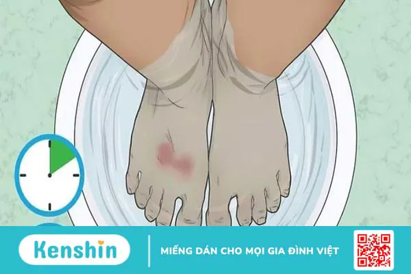 Bị bỏng nên làm gì? 12 mẹo trị phỏng nước sôi, bỏng lửa hiệu quả