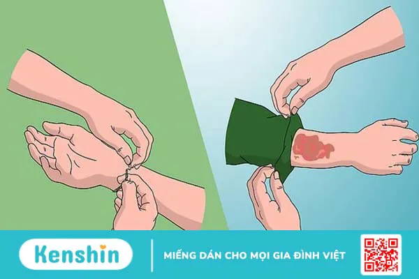 Bị bỏng nên làm gì? 12 mẹo trị phỏng nước sôi, bỏng lửa hiệu quả