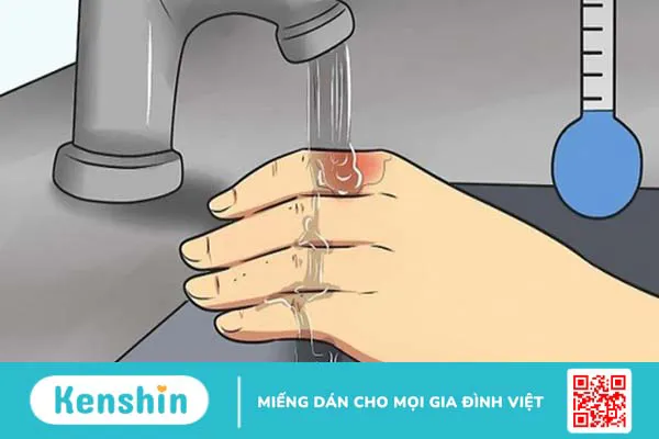 Bị bỏng nên làm gì? 12 mẹo trị phỏng nước sôi, bỏng lửa hiệu quả