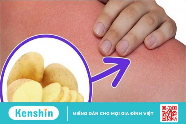 Bị bỏng nên làm gì? 12 mẹo trị phỏng nước sôi, bỏng lửa hiệu quả